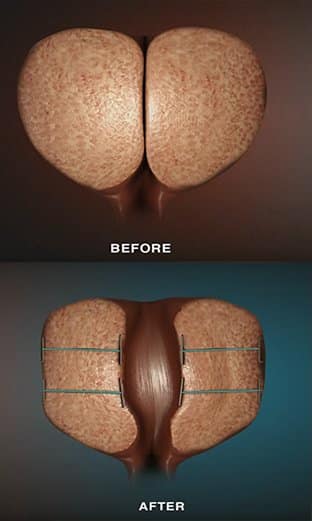 Prostate Cure After and Before