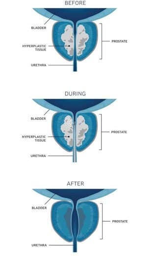 Prostate Cure Rezum Treatment After and Before